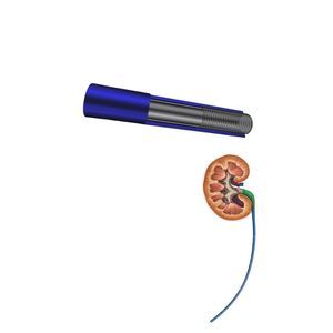 guaina di accesso ureterale