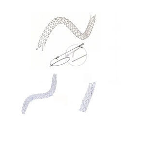 stent ureterale