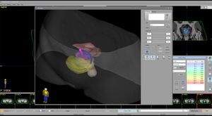 software per brachiterapia