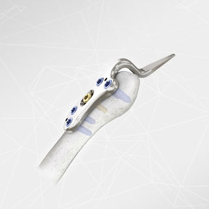 placca di compressione per rticolazione acromioclavicolare 1