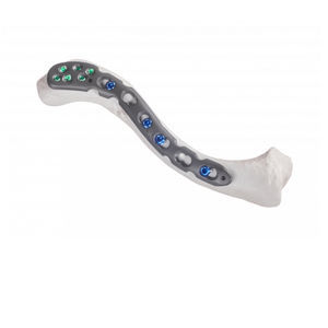 placca di compressione per clavicola 1