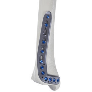 placca di compressione per tibia 1
