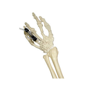 fissatore esterno per articolazione metacarpo-falangea 1