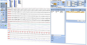 software per polisonnografia 1