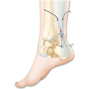protesi di legamento tendine calcaneale