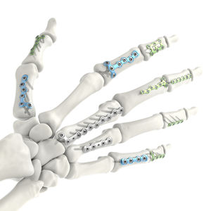 placca di compressione per falange della mano