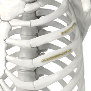 placca di compressione per costole