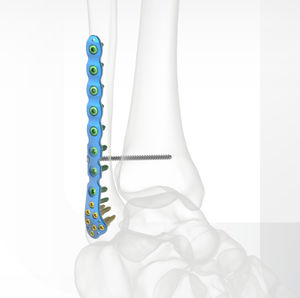 placca di compressione per fibula