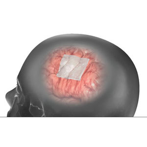 protesi di sostituzione della dura madre tendine calcaneale bovino
