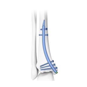 chiodo intramidollare per tibia 1