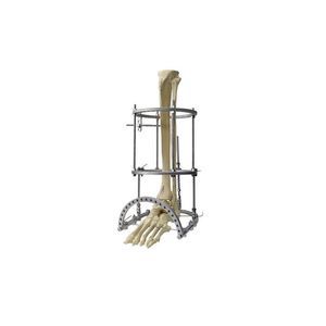 fissatore esterno per tibia 1