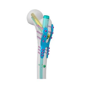 placca di compressione per trocantere 1