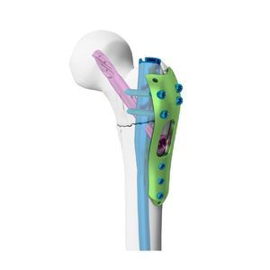 placca di compressione per trocantere 1
