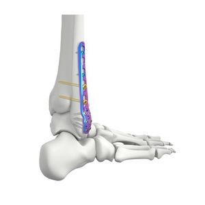 placca per osteotomia per fibula 1