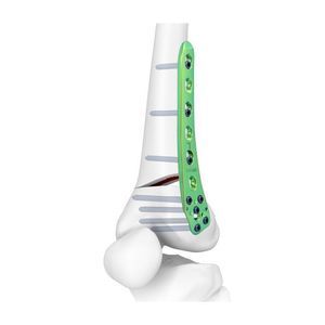 placca per osteotomia per femore