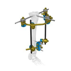 fissatore esterno per tibia 1