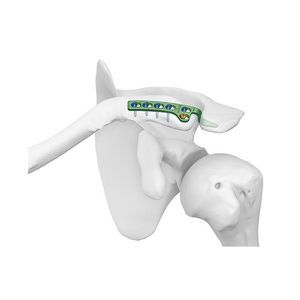 placca di compressione per clavicola 1