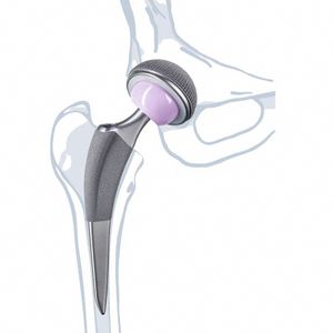 protesi di anca di prima intenzione