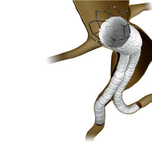 innesto stent aorta addominale