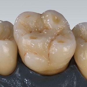 materiale odontoiatrico in zircone / per ponti dentali / per corone dentali / per perni monconi