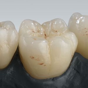 materiale odontoiatrico in ceramica / per corone dentali / ad alta traslucidità