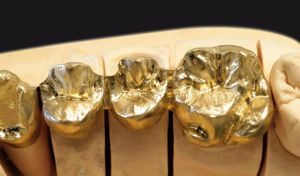 materiale odontoiatrico in metallo 1