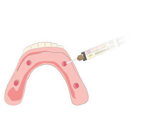 adesivo dentale per sistemi implantari