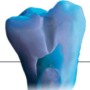 materiale odontoiatrico in ceramica