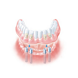 pilastro dentale per impianto dritto