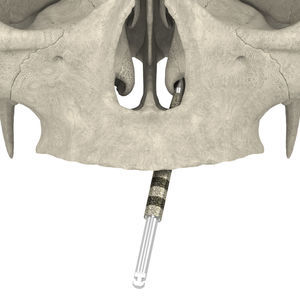 punta per implantologia dentale 1
