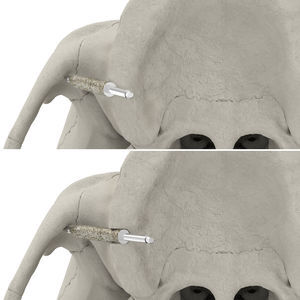 punta per osteotomia pre-impianto 1