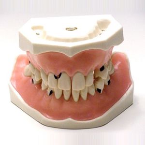 modello anatomico di dentatura / ad uso didattico / di patologia / per parodonzia