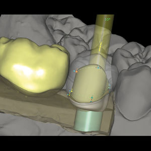 modulo software di progettazione di protesi dentale / di fabbricazione / per laboratorio odontotecnico