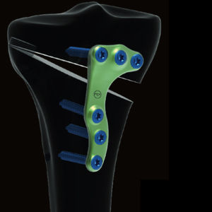 placca per osteotomia per tibia