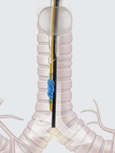bloccatore endobronchiale a doppio lume 1