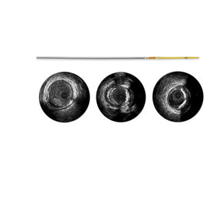 catetere diagnostico 1
