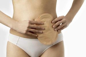 sacca per ileostomia 1