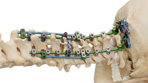 sistema di osteosintesi occipito-cervico-toracico