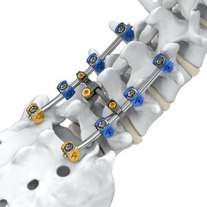 sistema di osteosintesi lombo-sacrale