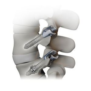 vite pedicolare vertebra toraco-lombare / monoassiale