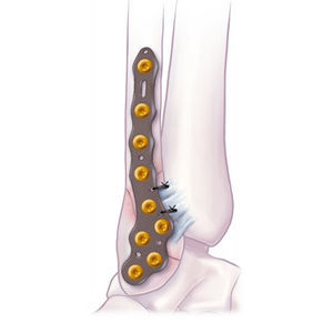 placca di compressione per fibula