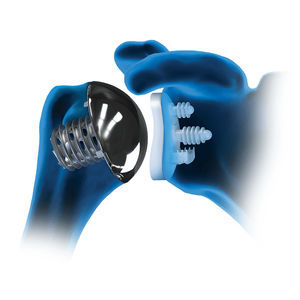 protesi della spalla cementata o non cementata