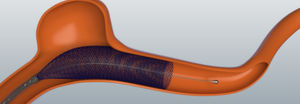 stent intracranico / in nitinol / autoespandibile