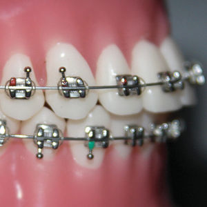 bracket ortodontici in metallo 1