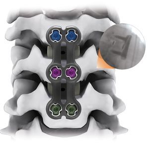 placca per artrodesi per vertebra cervicale 1