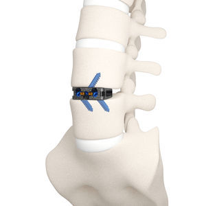 gabbia intersomatica lombare 1