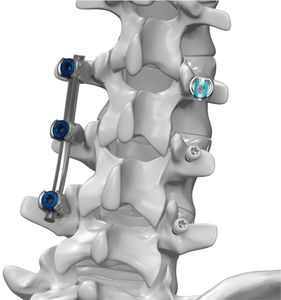sistema di osteosintesi toraco-lombare