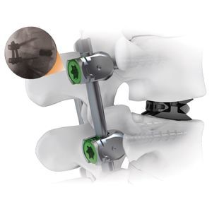 sistema di osteosintesi toraco-lombare