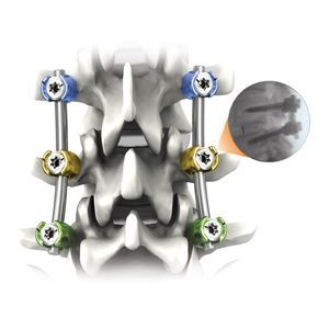 sistema di osteosintesi toraco-lombare