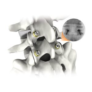 sistema di osteosintesi toraco-lombare
